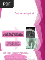 Quiste Periapical