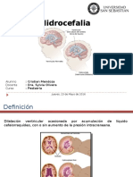 Hidrocefalia Pediatría