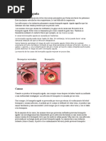 Bronquitis Aguda