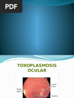 Toxoplasmosis Ocular