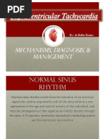 Supraventricular Tachycardia