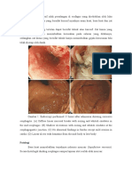 Esofagitis Korosif