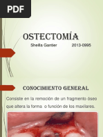 Ostectomía