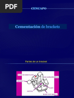 Cementación de Brackets.