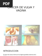 Cancer de Vulva y Vagina