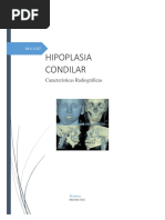 Hipoplasia Condilar