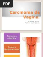 Carcinoma de Vagina