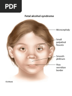 Fetal Alcohol Syndrome