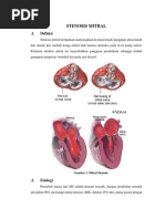 MItral Stenosis