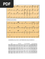 Hemibloqueo Posteroinferior