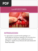 La APICECTOMIA