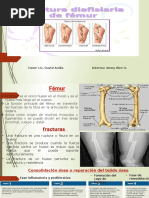 FX Diafisis Femoral