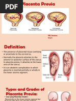 Placenta Previa