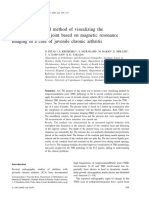 A Three-Dimensional Method of Visualizing The Temporomandibular Joint Based On Magnetic Resonance Imaging in A Case of Juvenile Chronic Arthritis