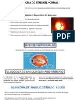 Glaucoma de Tensión Normal