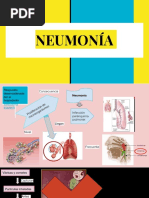 Neumonia