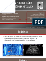 Colecistitis Aguda