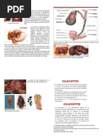 Colecistitis