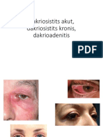 Dakriosistits Akut, Dakriosistits Kronis, Dakrioadenitis