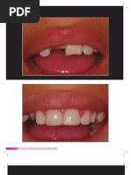 Caso Clínico - Restauração Direita de Dente Anterior Fraturado Com Pinos.