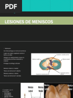 Lesiones de Meniscos