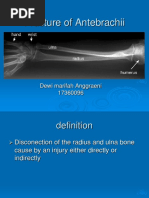 Fracture of Radius, Ulna, and Humerus