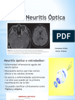 Neuritis Óptica