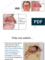 Polip Nasi