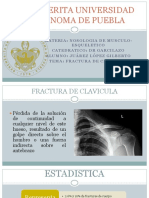 Fractura de Clavicula