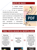 Quistes de Nuck Cirugia Pedriatica