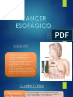 Cancer Esofago