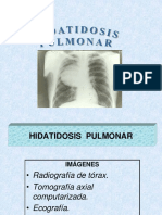 002a HIDATOSIS PULMONAR