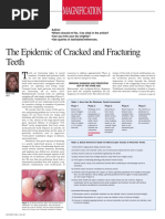 The Epidemic of Cracked and Fractured Teeth