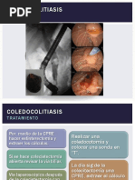 Coledocolitiasis