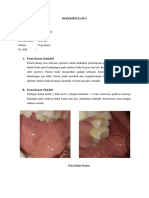 Fordyce Granule