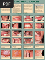 Detecting Oral Cancer