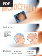 MICROCEFALIA