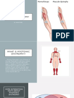 Myotonic Dystrophy: By: Aakash Reddy