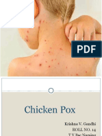 Chicken Pox