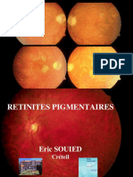 Retinites Pigmentaires