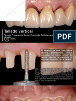 Tallado Vertical