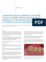 6 Composite Palatal Veneers To Restore A Case of Severe Dental Erosion