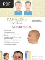 Parálisis Facial