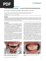 Think Before You Extract - A Case of Tooth Autotransplantation