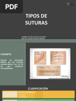 Tipos de Sutura-Ilsa