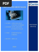 Implantes Dentales