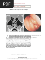 Left Nasal Discharge and Meningitis: Images in Clinical Medicine