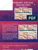 Ingrown Toe Nail: Why Do They Happen: Warning This Presentation May Contains Sensitive Content