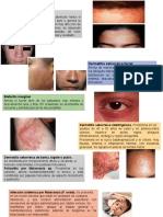 Dermatitis Seborreica 3