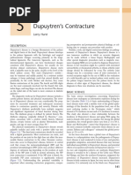 5 - Dupuytren's Contracture